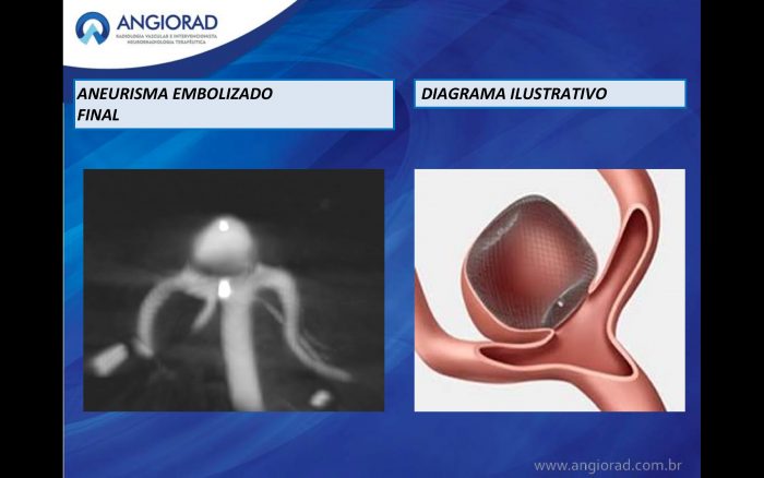 Tratamento Endovascular De Aneurisma De Topo De Basilar E Colo Largo Com Dispositivo Web Woven Endobridge Agosto 2019 Angiorad